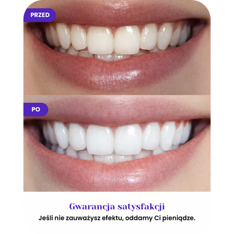 Wie funktioniert der violette Zahnkorrektor V34 Elixio?